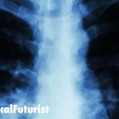 future_pneumonia_lungs