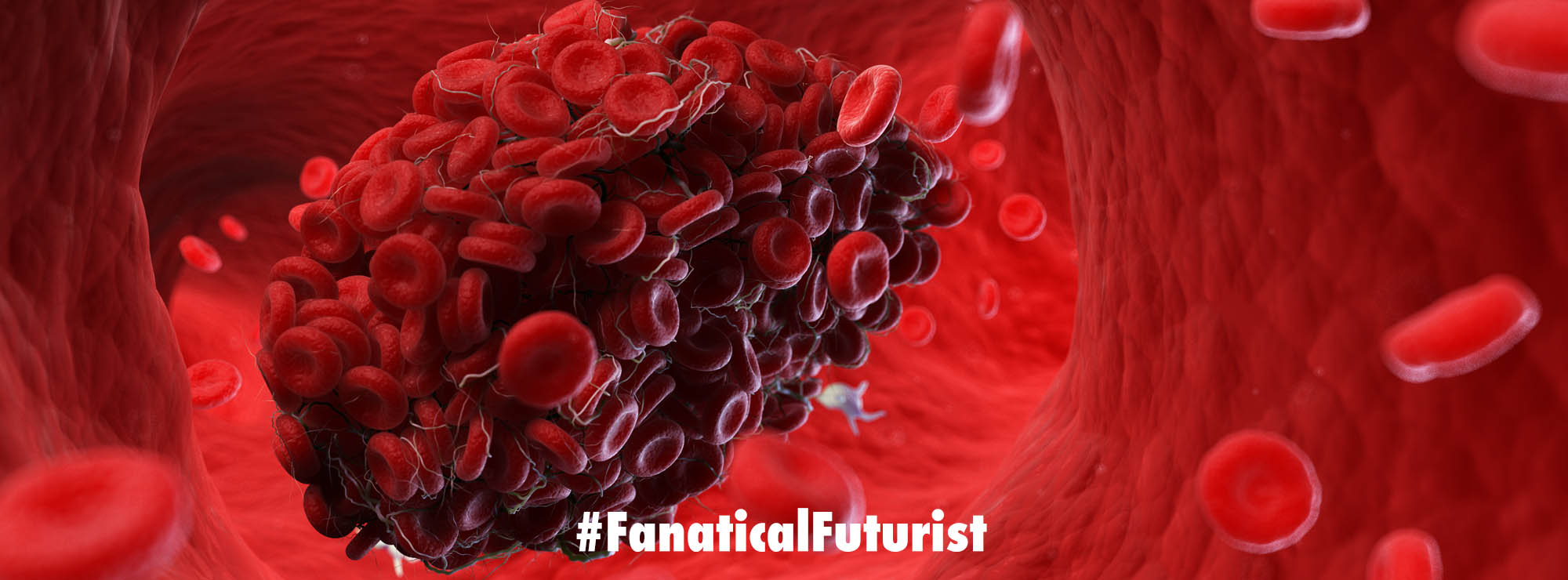 A new medical device uses twisted ultrasound to eliminate blood clots